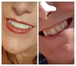 Roma Faccette Dentali prima e dopo