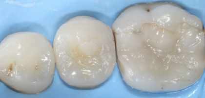 Otturazione dente dentista roma