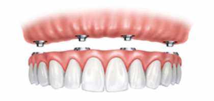 Impianti Overdenture