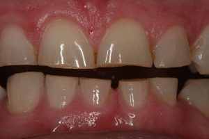 abrasione dentale Dentista Roma