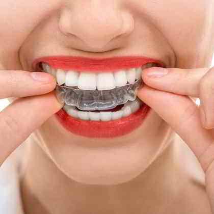 Apparecchio invisalign roma