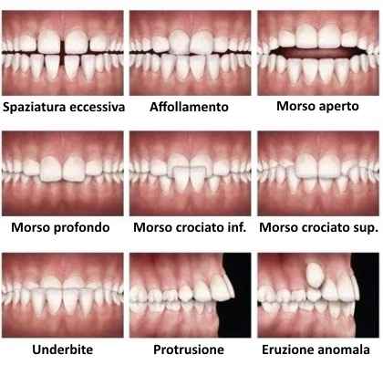 dentista roma classificazione malocclusioni morso