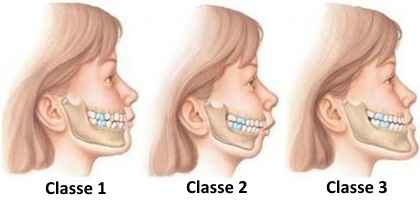 dentista roma classificazione malocclusioni