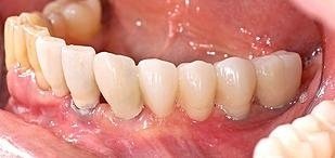dentista roma Impianti Dentali