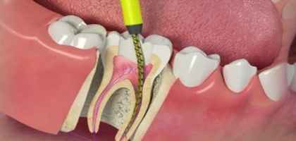 Corone dentali metal-free dentista roma
