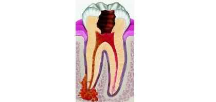Cura del Granuloma dentale
