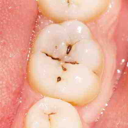 dentista roma Cura della carie dentale
