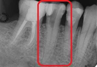 dente da devitalizzare