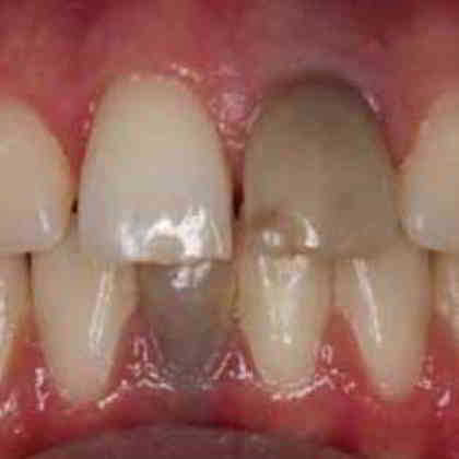dente nero Roma Dentista