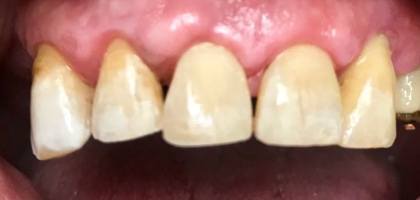 macchie scure denti - dopo intervento rimozione