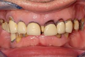 diastema da parodontite