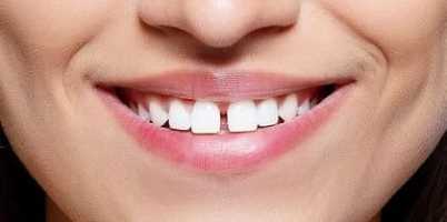 diastema:spazio tra i denti roma
