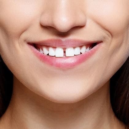 diastema lo spazio in mezzo ai denti