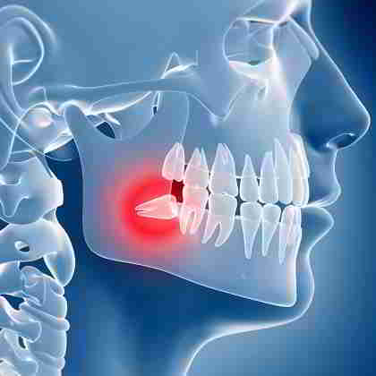 dentista roma Estrazione dei denti del giudizio