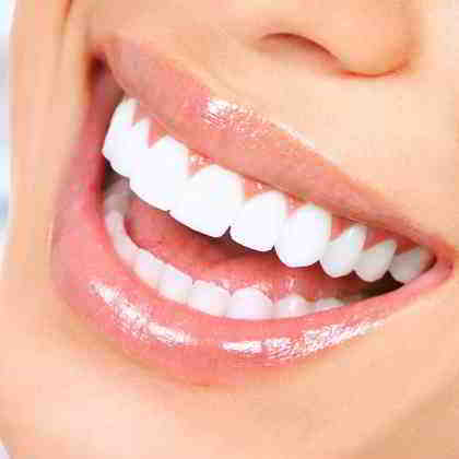 Faccette Dentali dentista roma 