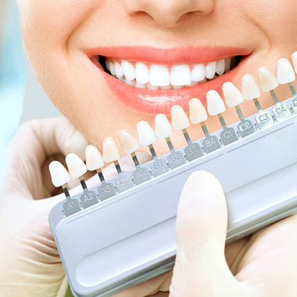 dentista roma faccette dentali Lumineers