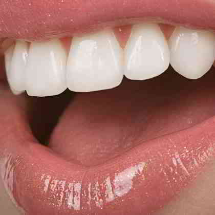 dentista roma faccette dentali Lumineers