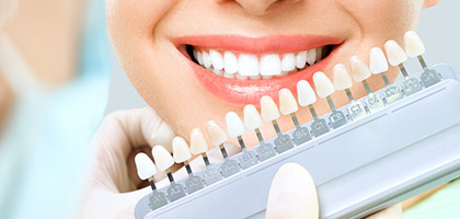 offerta Faccette dentali