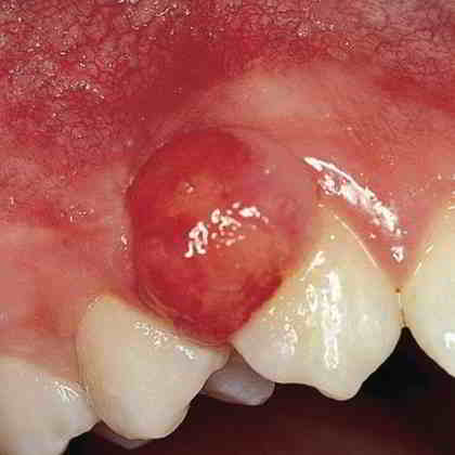 dentista roma Cura del Granuloma dentale