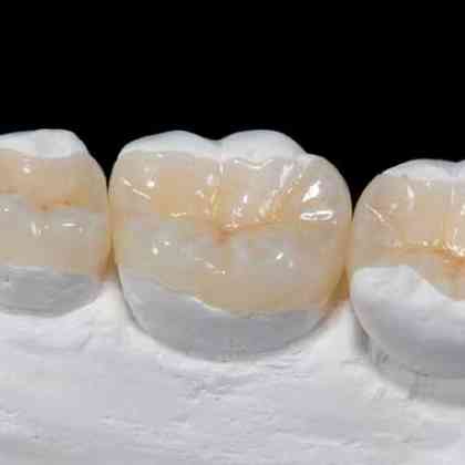 dentista roma Intarsi dentali