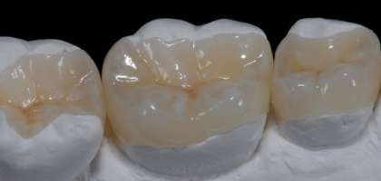 Intarsi dentali dentista roma