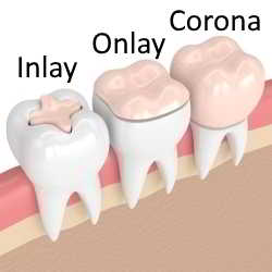 Intarsio dentale Inlay Onlay Corona