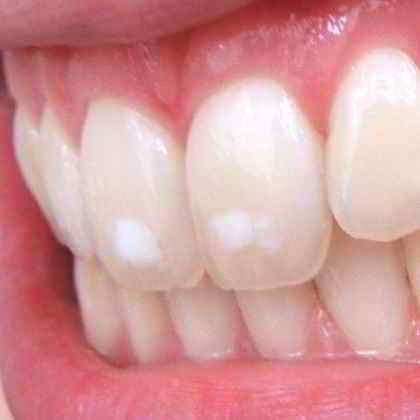 dentista roma Corone dentali Zirconio / Disilicato di litio (Metal Free)