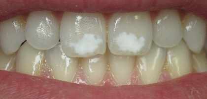 Macchie bianche denti