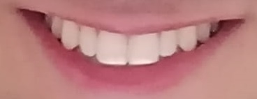 macchie bianche denti dentista roma