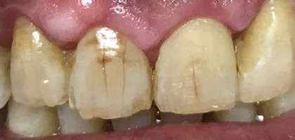 macchie scure / nere sui denti dentista roma