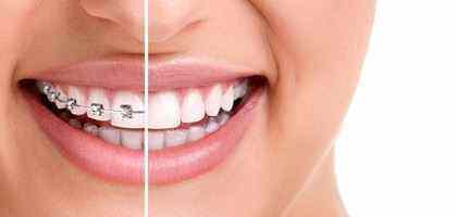 Ortodonzia, apparecchi invisibili, fissi, mobili dentista roma