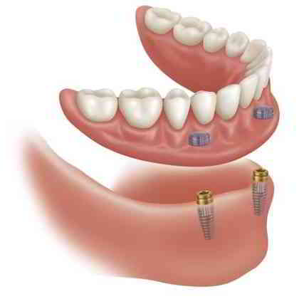 dentista roma Impianti Overdenture