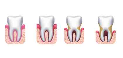 Parodontite - Periodontite dentista roma