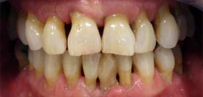 Parodontite dentista roma