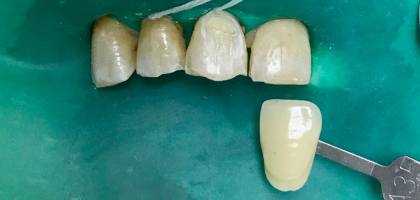 macchie scure denti - posizionamento diga identificazione colore