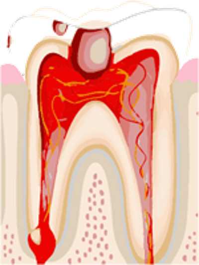 pulpite acuta Dentista Roma