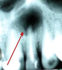 dentista roma radiografia Granuloma dentale