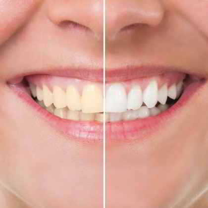 sbiancamento denti Roma Dentista