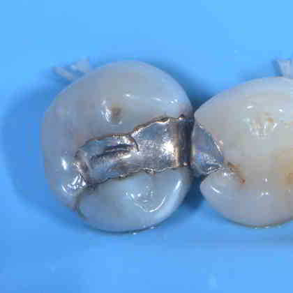 dentista roma Sostituzione delle Otturazioni in Amalgama