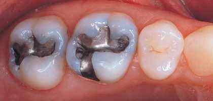 Sostituzione delle Otturazioni in Amalgama