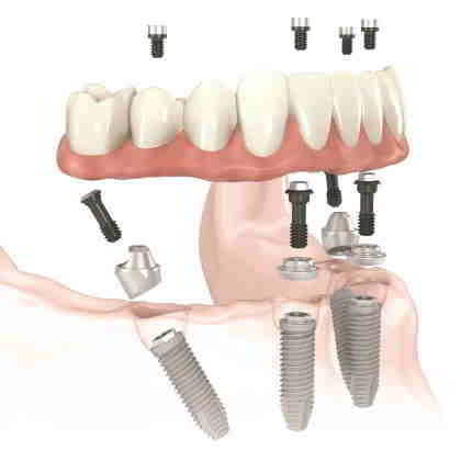 dentista roma Toronto Bridge protesi fissa